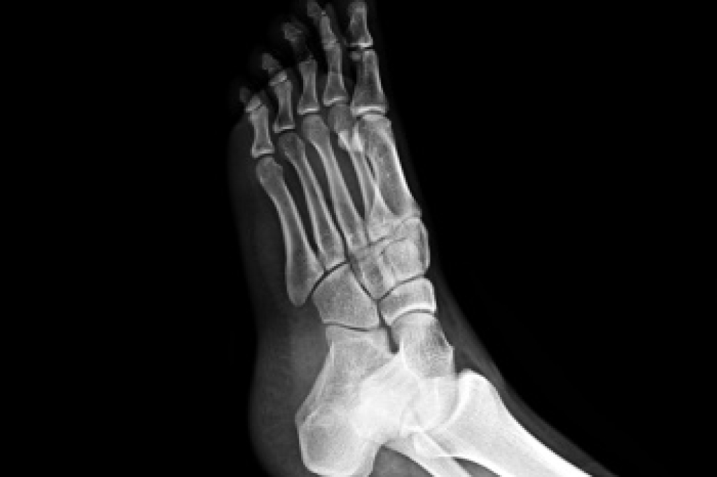 Metatarsal Bone Fractures