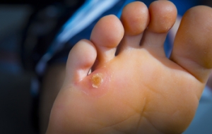 Managing Corns and Calluses