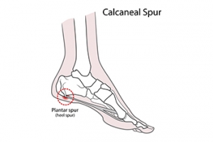 Do Heel Spurs Go Away?
