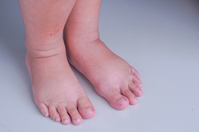 Swollen Feet and Ankles During Pregnancy