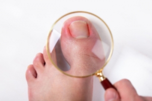 Managing Ingrown Toenails