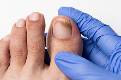 Do You Have Ugly Toenails?